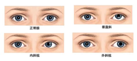 斜视|Strabismus